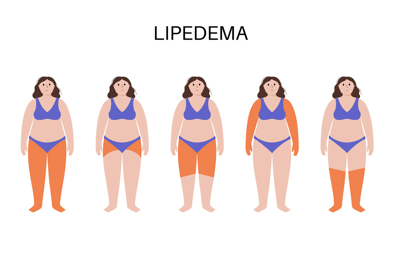 stati del lipedema