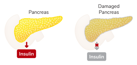 pancreas insulina